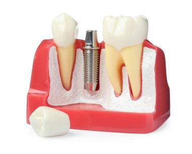 Beyaz arka planda dişler arasında diş implantı olan eğitim modeli