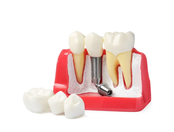 Освітня Модель Імплантацією Зубів Корон Білому Тлі — стокове фото