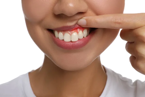 Young Woman Showing Inflamed Gums Closeup View — Stock Photo, Image