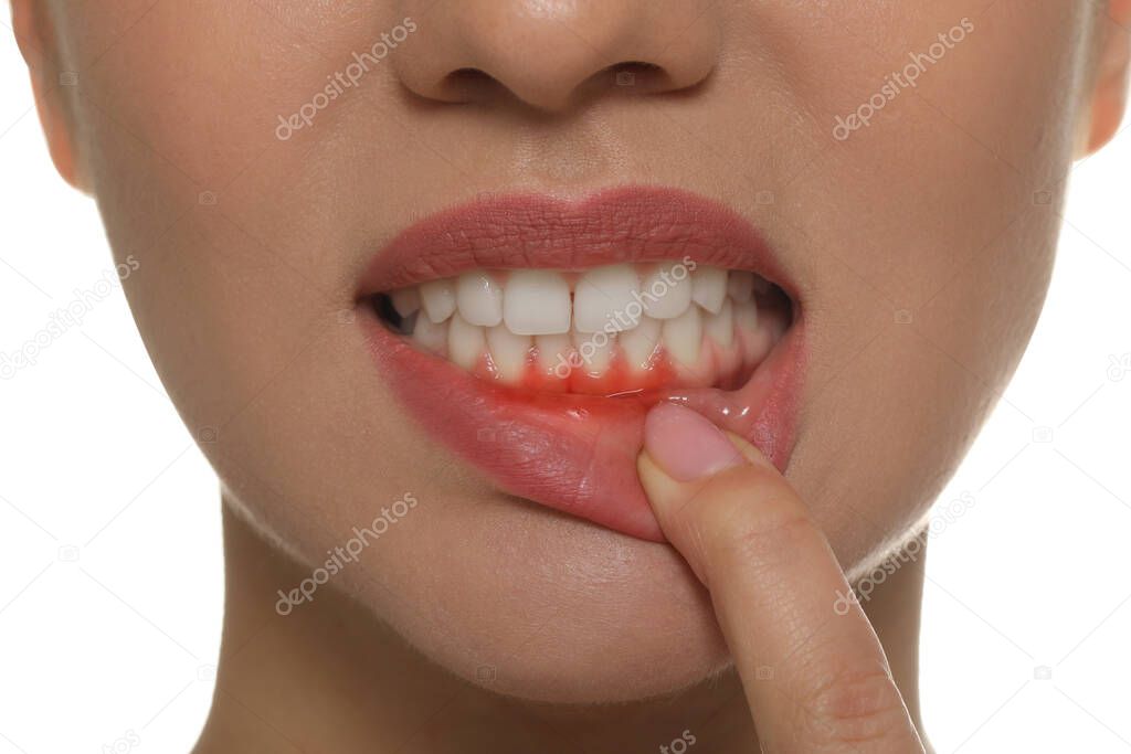 Young woman showing inflamed gums, closeup view