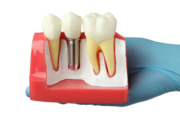 Dentysta Posiadający Model Edukacyjny Gumy Implantem Stomatologicznym Między Zębami Białym — Zdjęcie stockowe