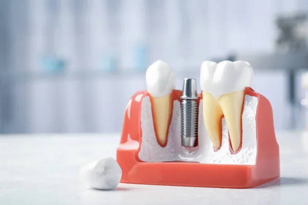 Освітня Модель Постами Абатством Зубного Імплантату Між Зубами Білому Столі — стокове фото