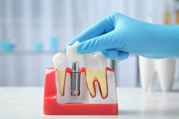 Dentysta Zakładający Koronę Czubek Implantu Stomatologicznego Między Zębami Przy Stole — Zdjęcie stockowe