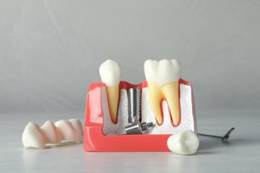 Diş implantı ve beyaz ahşap masa taçlarının arasına diş implantı için yapıştırılmış eğitim modeli.