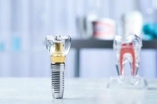 Modelo Educacional Implante Dentário Mesa Leve Dentro Casa Espaço Para — Fotografia de Stock