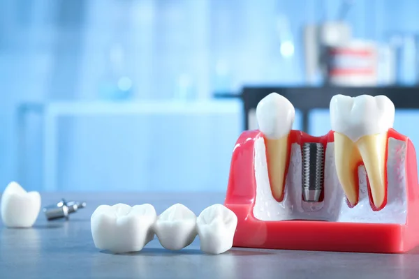 Освітня Модель Постами Зубного Імплантату Між Зубами Коронками Столі Приміщенні — стокове фото