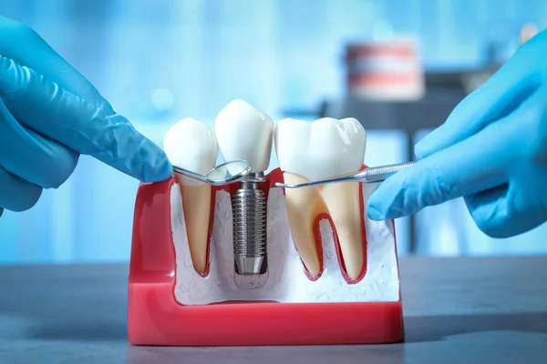 Dentysta Narzędziami Wskazującymi Implant Stomatologiczny Między Zębami Modelu Edukacyjnym Pomieszczeniach — Zdjęcie stockowe