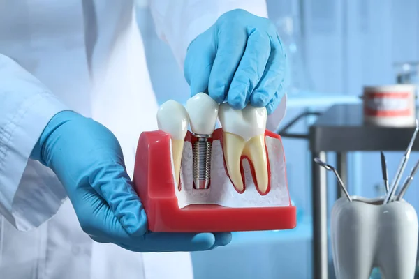 Dentist Holding Educational Model Gum Dental Implant Teeth Indoors Closeup — Zdjęcie stockowe