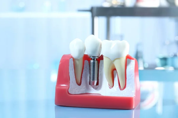 Educational Model Gum Dental Implant Teeth Indoors — Stockfoto