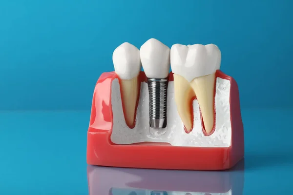 Educational Model Gum Dental Implant Teeth Light Blue Background — Stockfoto