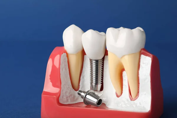 Освітня Модель Гумки Зубною Імплантацією Між Зубами Синьому Фоні Крупним — стокове фото