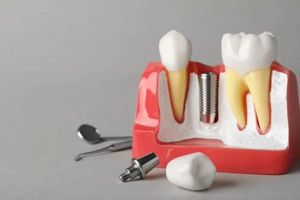 Educational Model Gum Post Dental Implant Teeth Crown Grey Background — Stockfoto