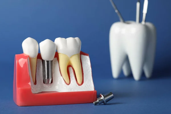 Model Edukacyjny Gumy Implantem Dentystycznym Między Zębami Niebieskim Tle Miejsce — Zdjęcie stockowe