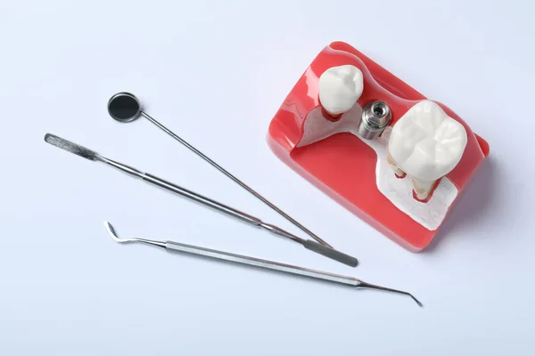 Educatief Model Van Tandvlees Met Post Voor Tandheelkundig Implantaat Tussen — Stockfoto