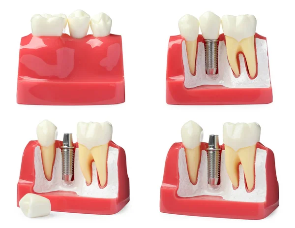 Educational Models Gum Dental Implant Teeth White Background Collage — Stock Photo, Image