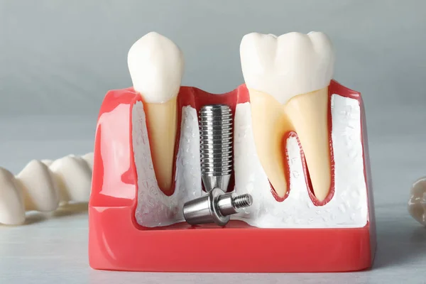 Освітня Модель Гумки Постами Зубного Імплантату Між Зубами Коронками Білому — стокове фото