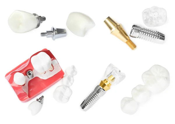 Modelos Educativos Implantes Dentales Sobre Fondo Blanco Vista Superior Collage — Foto de Stock
