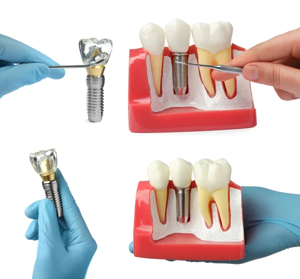 Dentyści Pokazujący Modele Edukacyjne Implantów Stomatologicznych Białym Tle Zbliżenie Kolaż — Zdjęcie stockowe