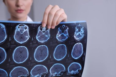Doktor, klinikte çoklu sklerozlu hastanın MRI görüntülerini inceliyor.