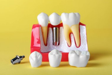 Sarı arka plandaki dişler arasında diş implantı için post ve taçlı eğitim modeli.