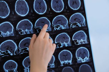 Doktor, klinikte çoklu sklerozlu hastanın MRI görüntülerini inceliyor.