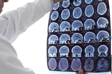 Doktor, klinikte çoklu sklerozlu hastanın MRI görüntülerini inceliyor.