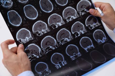 Doktor, beyaz masadaki çoklu sklerozlu hastanın MRI görüntülerini inceliyor.