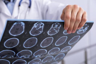Doktor, klinikte çoklu sklerozlu hastanın MRI görüntülerini inceliyor.