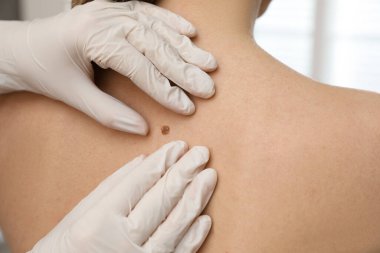 Dermatolog klinikte hastanın doğum lekesini inceliyor.