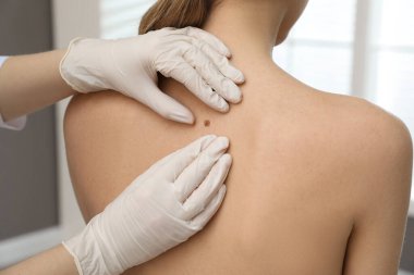 Dermatolog klinikte hastanın doğum lekesini inceliyor.