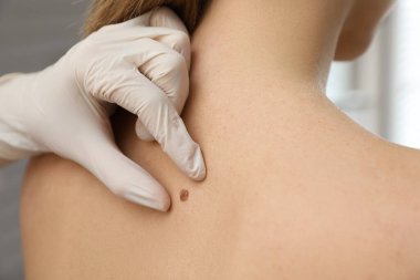 Dermatolog klinikte hastanın doğum lekesini inceliyor.