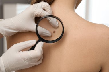 Dermatolog, klinikte büyüteçle hastanın doğum lekesini inceliyor.