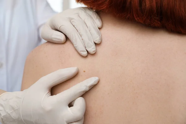 Dermatologe Untersucht Muttermal Des Patienten Klinik Nahaufnahme — Stockfoto