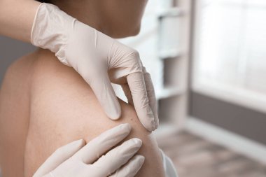 Dermatolog klinikte hastanın doğum lekesini inceliyor.