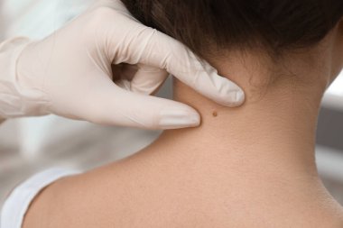 Dermatolog klinikte hastanın doğum lekesini inceliyor.