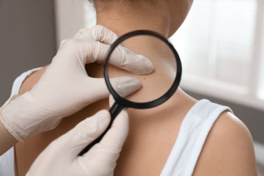 Dermatolog, klinikte büyüteçle hastanın doğum lekesini inceliyor.