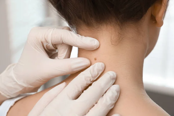 Dermatologe Untersucht Muttermal Des Patienten Klinik Nahaufnahme — Stockfoto