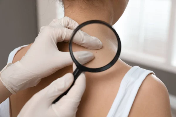 Dermatologista Examinando Marca Nascença Paciente Com Lupa Clínica Vista Perto — Fotografia de Stock