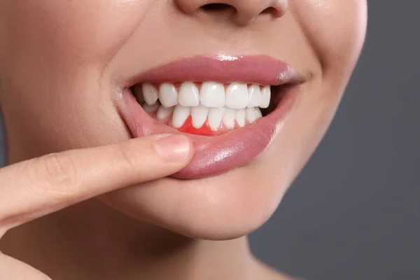 Junge Frau Zeigt Entzündetes Zahnfleisch Auf Grauem Hintergrund Nahaufnahme — Stockfoto