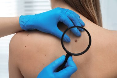 Dermatolog, klinikte büyüteçle hastanın doğum lekesini inceliyor.