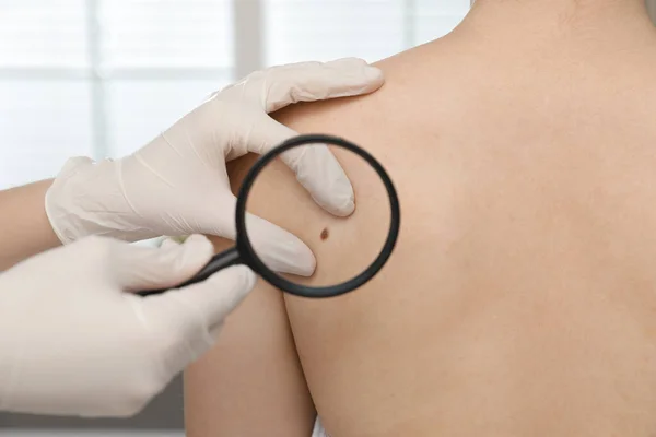 Dermatólogo Examinando Marca Nacimiento Del Paciente Con Lupa Clínica Vista — Foto de Stock