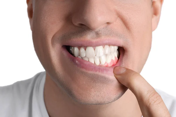 Hombre Mostrando Encías Inflamadas Sobre Fondo Blanco Primer Plano — Foto de Stock