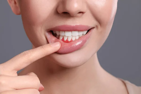 Mujer Joven Mostrando Encías Inflamadas Sobre Fondo Gris Primer Plano — Foto de Stock