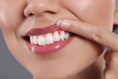 Gri arka planda iltihaplı diş etleri gösteren genç bir kadın. Yakın plan.