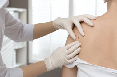 Dermatolog klinikte hastanın doğum lekesini inceliyor.