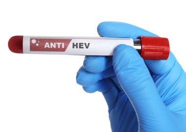 Bilim adamı elinde kan örneğiyle tüp tutuyor ve beyaz arkaplanda Anti HEV etiketi var, yakın plan.