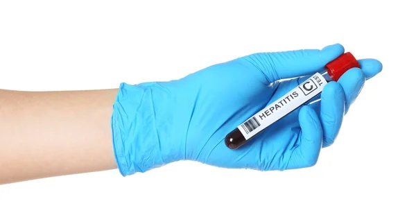 Scientist Holding Tube Blood Sample Label Hepatitis White Background Closeup — Stock Photo, Image