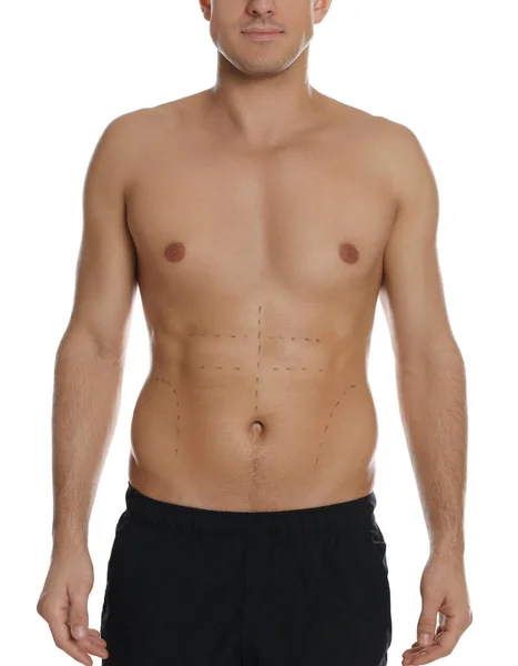 白い背景に体に印をつけた男を閉じます 減量手術 — ストック写真