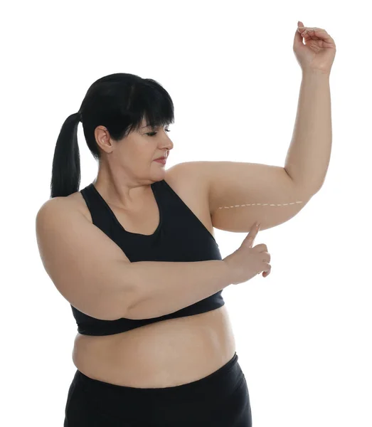 Fettleibige Frau Mit Schlaffem Arm Auf Weißem Hintergrund Operation Zur — Stockfoto
