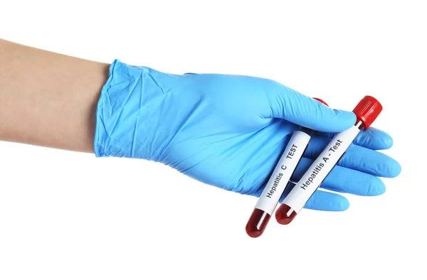 Wetenschapper Houdt Buizen Met Bloedmonsters Voor Hepatitis Virus Test Witte — Stockfoto